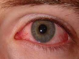 Eye Flu : जानिए Conjunctivitis से बचाव और राहत पाने के तरीके
